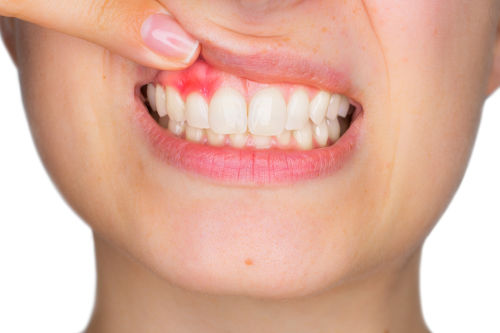 What Does It Mean If My Gums Are Bleeding Paradox Dental